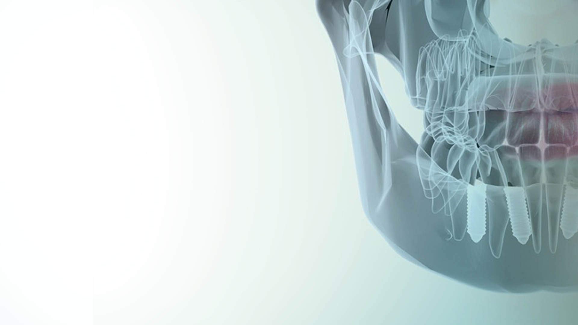 Implantologí­a Dental con Planificación digital
