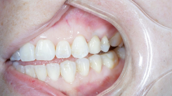 Implantologí­a Dental con Planifiación digital