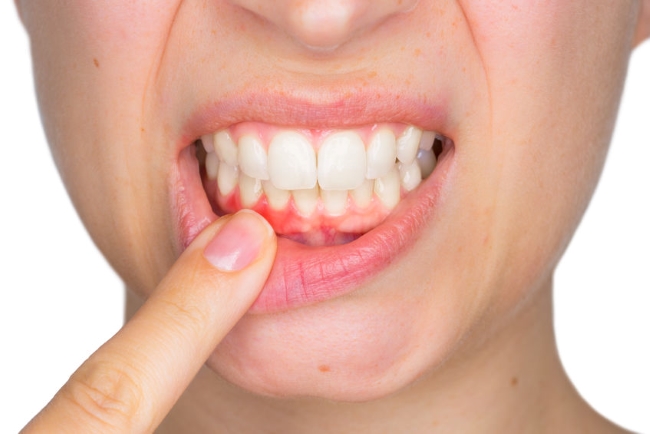 Si mis encí­as sangran al cepillarme  ¿debo preocuparme?